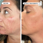 Refresh the look of dull skin with the Micro-Infusion Facial System