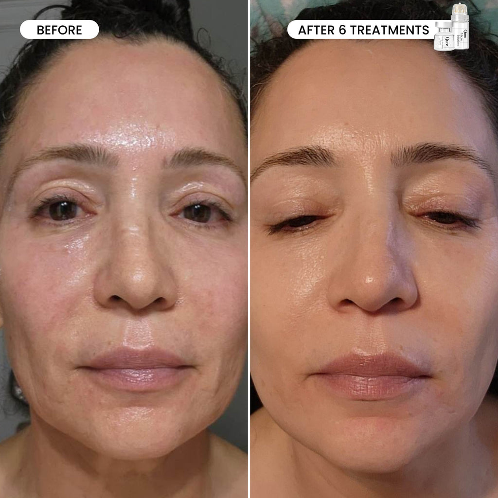 Refresh the look of dull skin with the Micro-Infusion Facial System