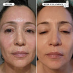 Refresh the look of dull skin with the Micro-Infusion Facial System